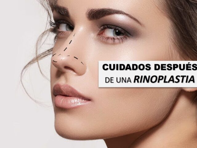 Rinoplastia, guía para tus cuidados postoperatorios